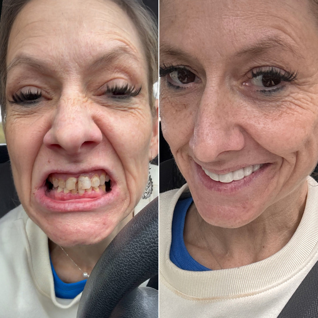 So easy to upgrade my smile!