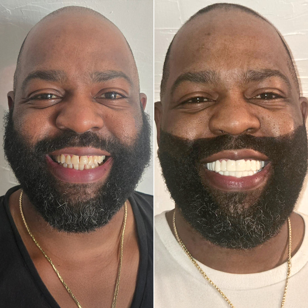 Pop On Veneers got me right