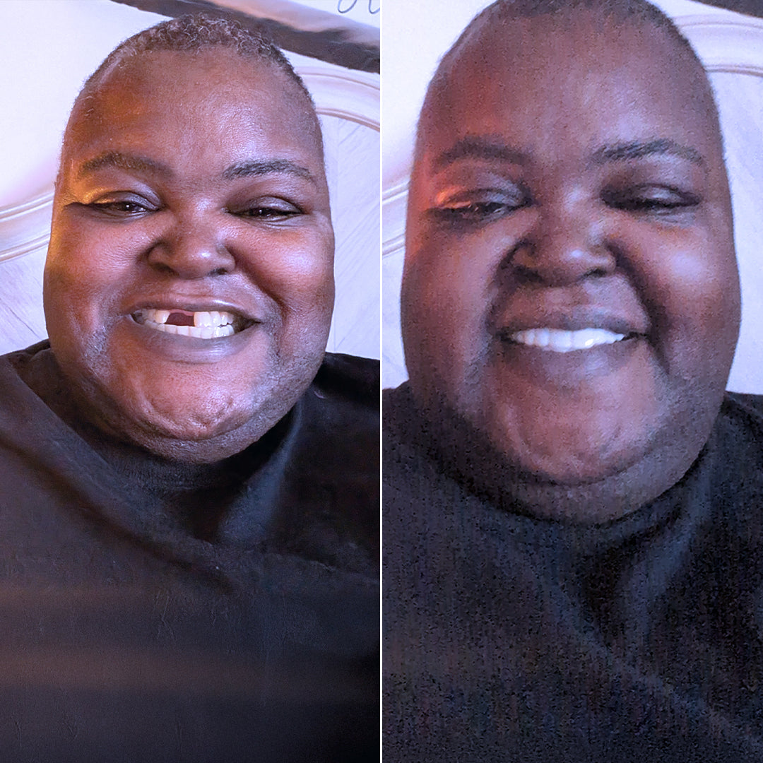 Got my smile back at 55!