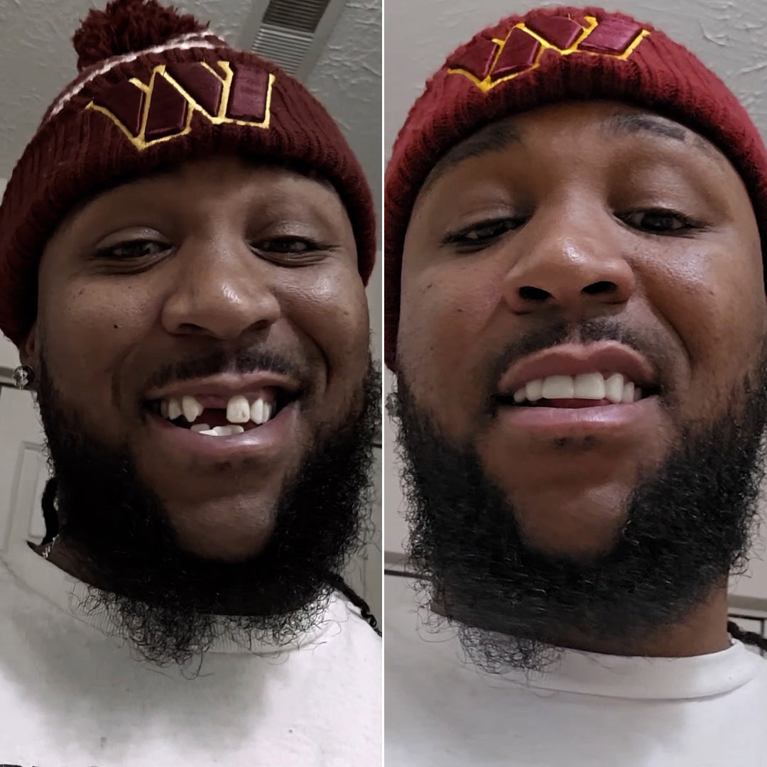 missing front teeth, confident, teeth spacing, fuller smile