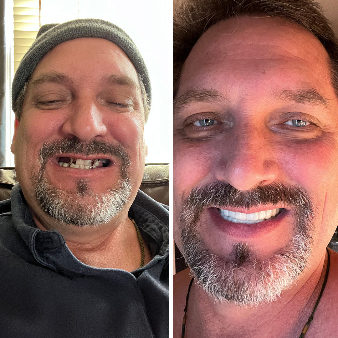 My smile is back!
