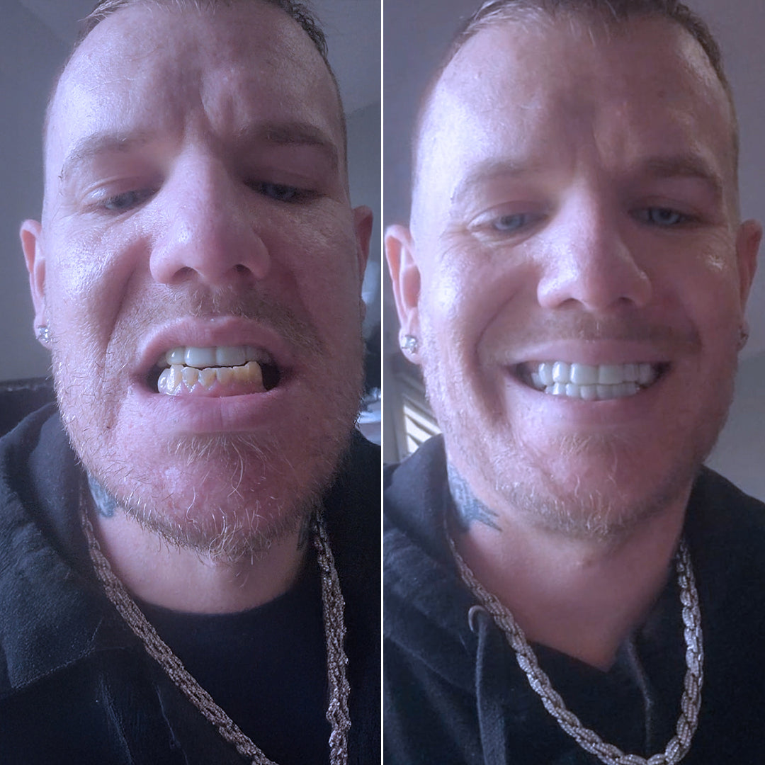 Pop On Veneers gave me a reason to smile again!