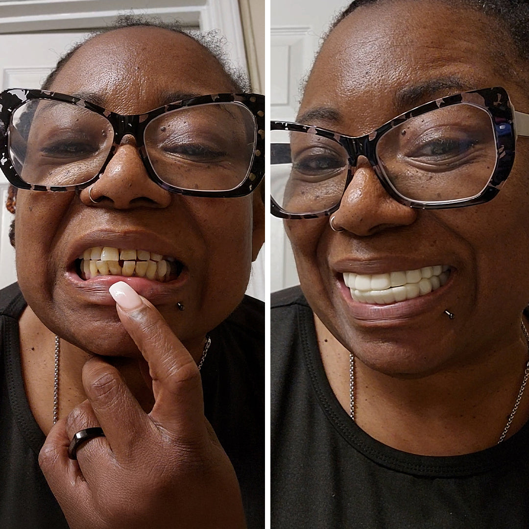 Got my smile back!