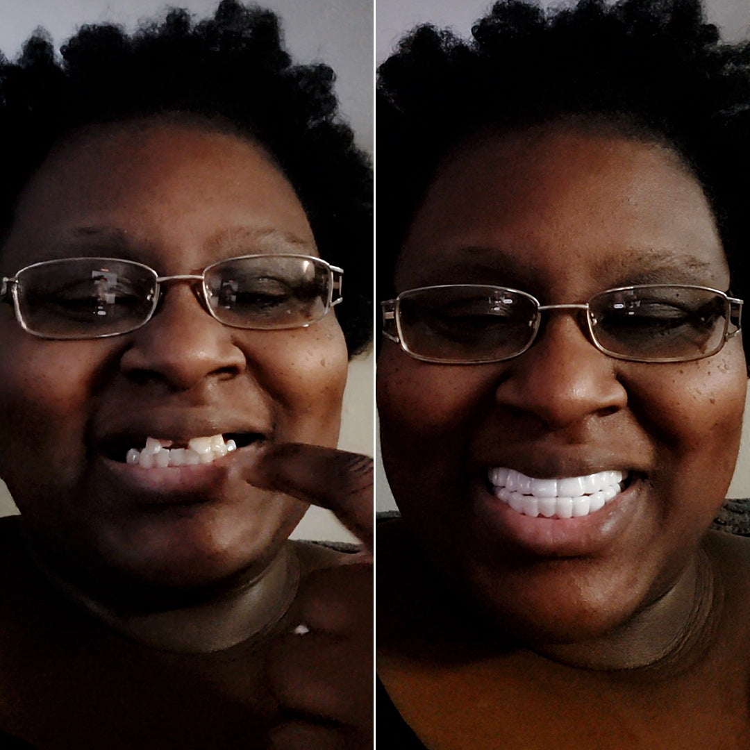 So excited about my new Pop On Veneers!