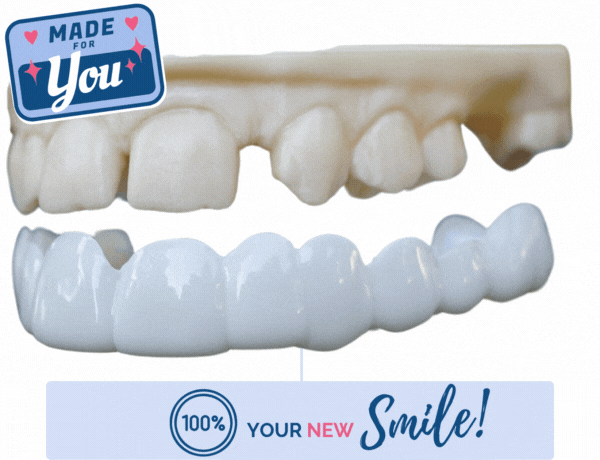 Veneers clipping on teeth gif